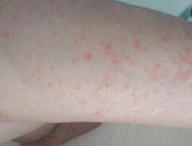 腿部湿疹出现的病因有什么