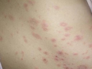 在生活中怎样的预防湿疹的产生