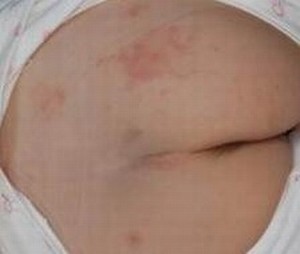 孕妇患有湿疹要怎么进行治疗