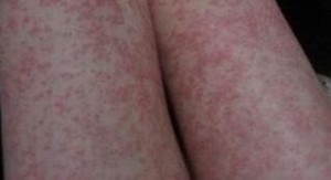 婴儿湿疹反作警惕特异性皮炎