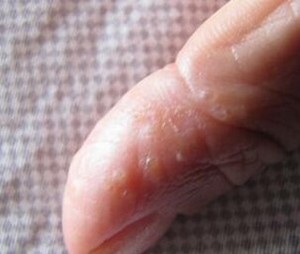 婴儿湿疹的主要症状是什么