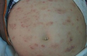 引起湿疹瘙痒的病因有什么