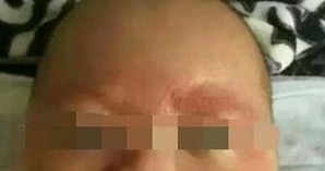 引起湿疹的原因详细的有什么