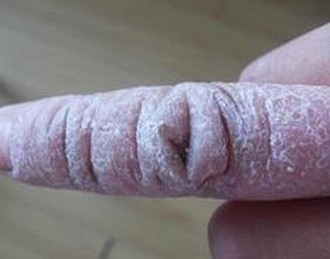 系统性硬皮病怎么治疗