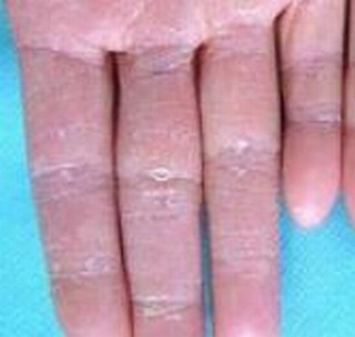 硬斑病患者该怎样自我保健护理呢