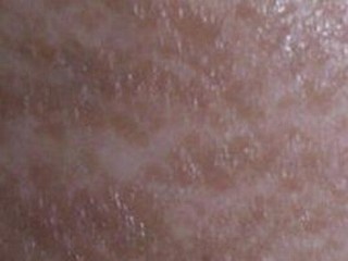 硬斑病究竟是否会传染呢