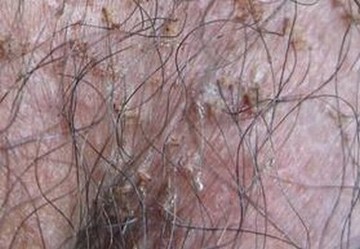 阴虱通过哪些途径传染的呢