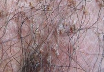 阴虱给患者带来的伤害有什么