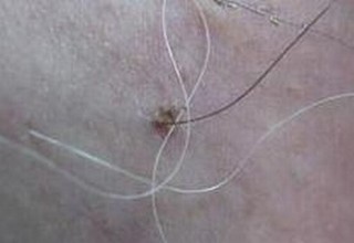 阴虱的明显症状有什么
