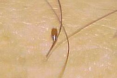 治疗阴虱病剃掉阴毛很关键