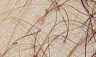 治疗阴虱有效的措施