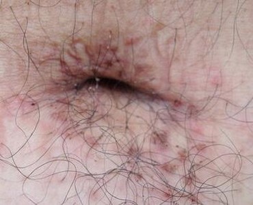 阴虱怎么检查