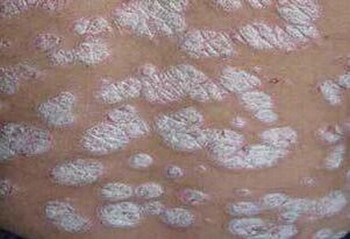 关节型银屑病与其他关节病的区分