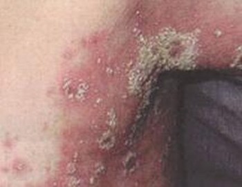关节型银屑病症状