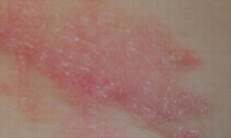 惊性格竟能诱发银屑病