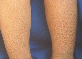 鱼鳞病治疗的手法