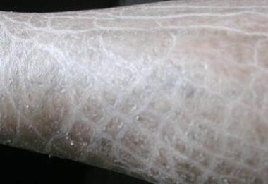 治鱼鳞病哪种治疗的手法好