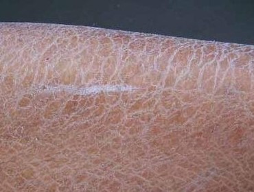 怎样科学护理鱼鳞病