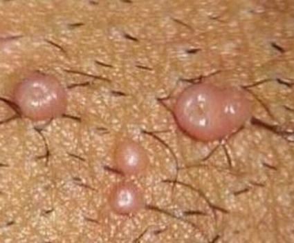 传染性软疣初期的图片