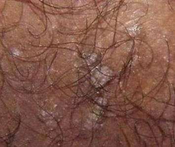 尖锐湿疣早期可以看到什么症状