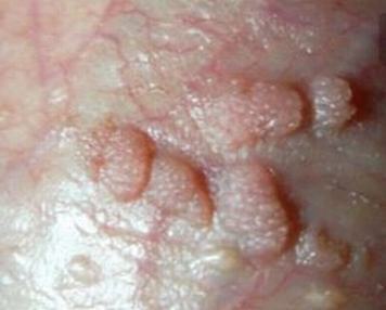尖锐湿疣最常见的发病部位