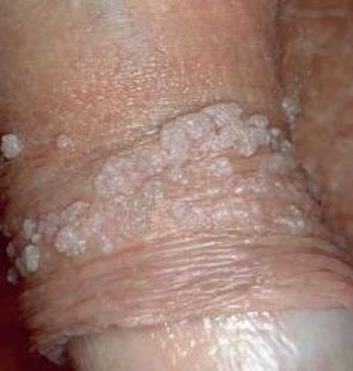 尖锐湿疣一般一年复发多少次