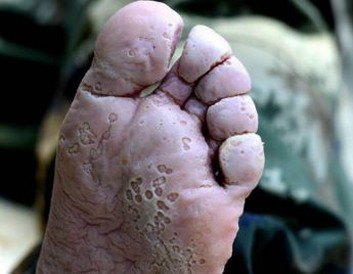 水疱型脚气症状