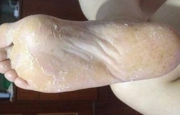 夏季脚气预防有奇招