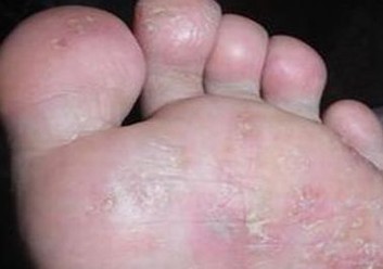 夏末初秋怎样预防脚气 