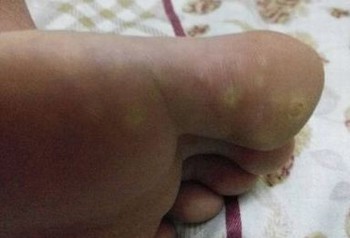 脚气怎么治才能除根呢