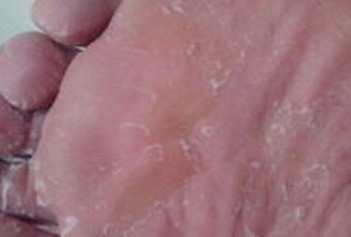 青岛治疗脚气的方法