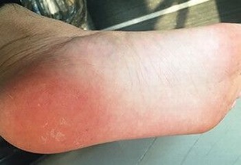 青岛治疗脚气的误区有什么