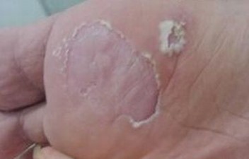 如何有效手段脚气