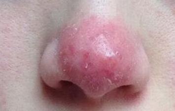 酒糟鼻应该怎样科学护理呢