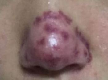 酒糟鼻患者的平时要注意