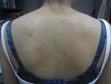毛囊炎和疖子如何区分