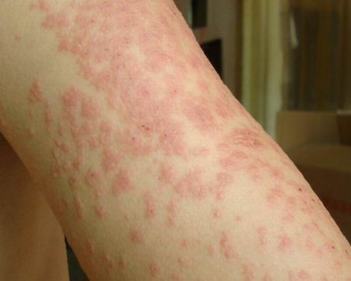 毛囊炎的症状及其病因
