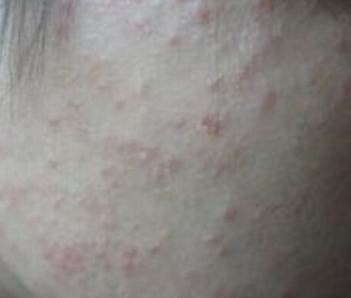 毛囊炎的症状特点是什么