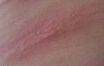 患上接触性皮炎不用怕