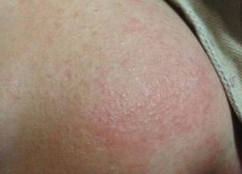 接触性皮炎不能吃什么