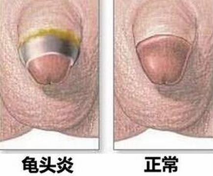 念珠菌龟头炎病人应注意清洁卫生