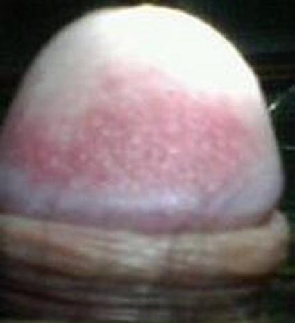 龟头炎的治疗措施