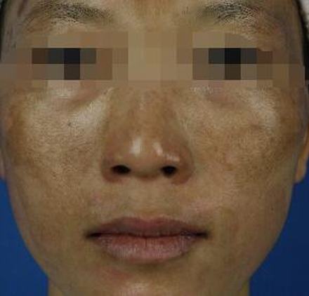 黄褐斑的治疗的手法