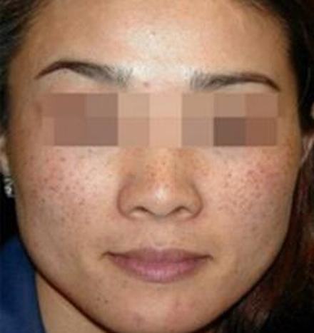 黄褐斑和雀斑的区别体现在哪