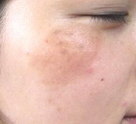 黄褐斑患者如何注意预防
