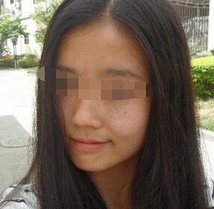 除掉黄褐斑的措施是什么