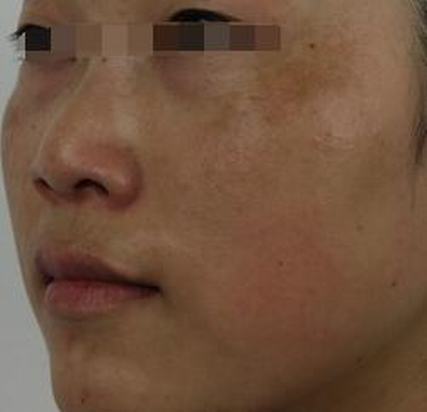 黄褐斑要如何治疗