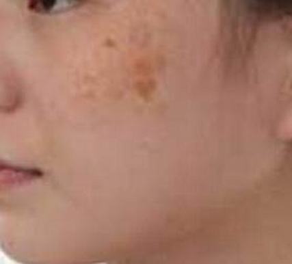 黄褐斑与肝功能有关吗