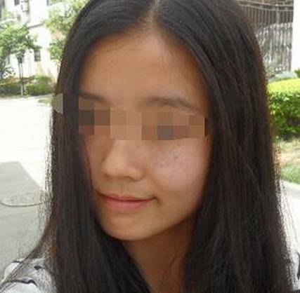 黄褐斑与雀斑的区别有哪些