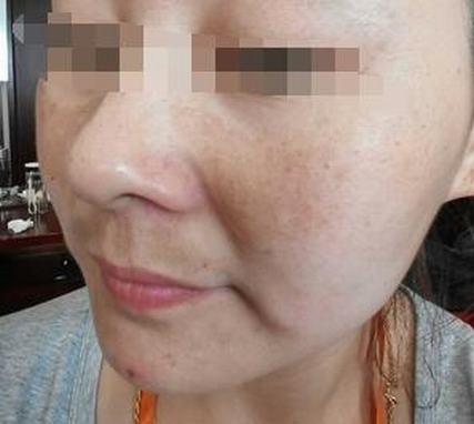 黄褐斑与雀斑知识